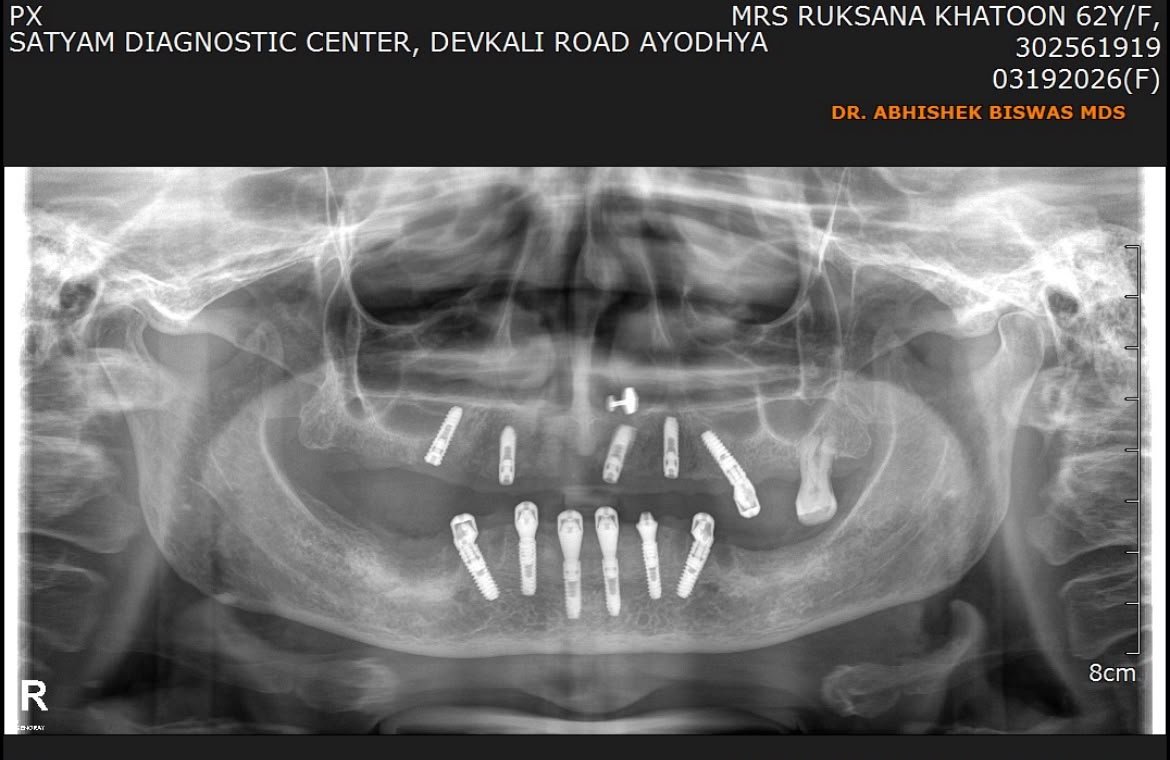 OPG Panoramic X-Ray showing dental implants
